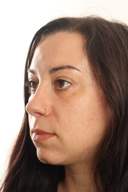 Blepharoplasty Before & After Patient #4437