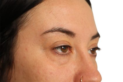 Blepharoplasty Before & After Patient #4437