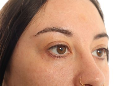 Blepharoplasty Before & After Patient #4437