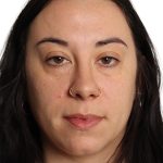 Blepharoplasty Before & After Patient #4437