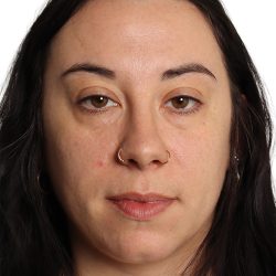 Blepharoplasty Before & After Patient #4437