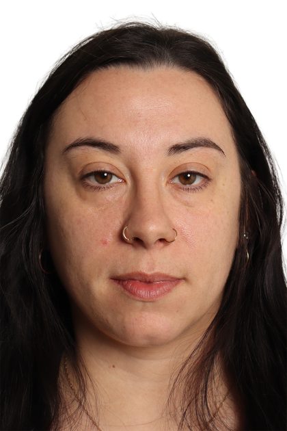 Blepharoplasty Before & After Patient #4437