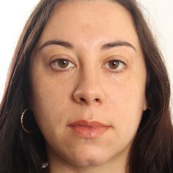Blepharoplasty Before & After Patient #4437