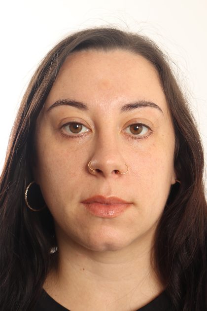 Blepharoplasty Before & After Patient #4437