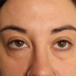Blepharoplasty Before & After Patient #4437