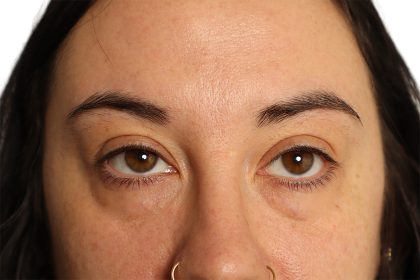 Blepharoplasty Before & After Patient #4437