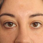 Blepharoplasty Before & After Patient #4437
