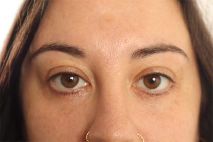 Blepharoplasty Before & After Patient #4437