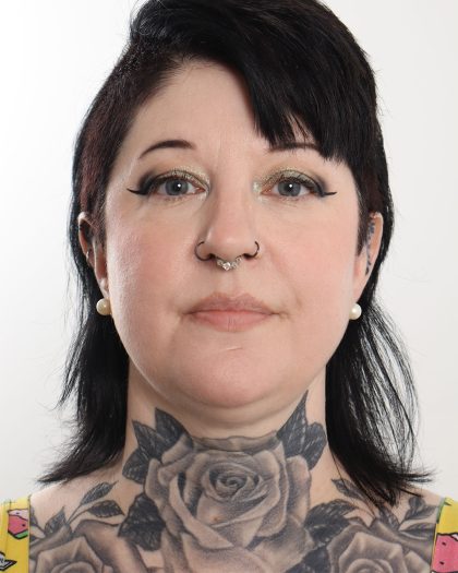 Neck Lift Before & After Patient #4423