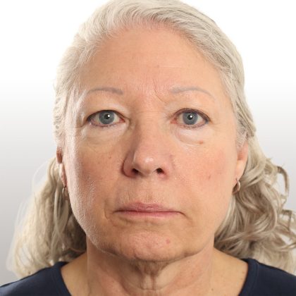Facelift Before & After Patient #4461