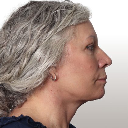 Facelift Before & After Patient #4461