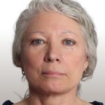 Facelift Before & After Patient #4461