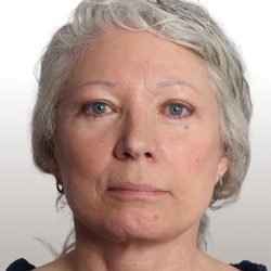 Facelift Before & After Patient #4461