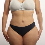 Tummy Tuck Before & After Patient #4452