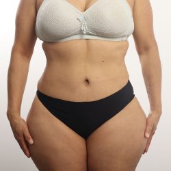 Tummy Tuck Before & After Patient #4452