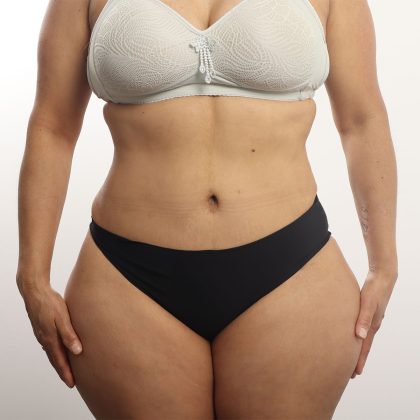 Tummy Tuck Before & After Patient #4452