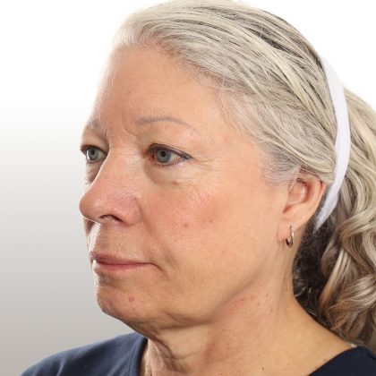 Facelift Before & After Patient #4461