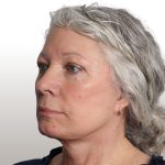 Facelift Before & After Patient #4461