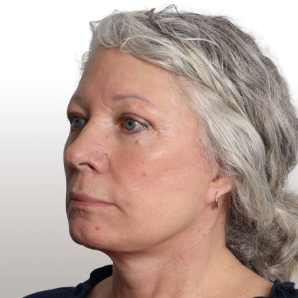 Facelift Before & After Patient #4461