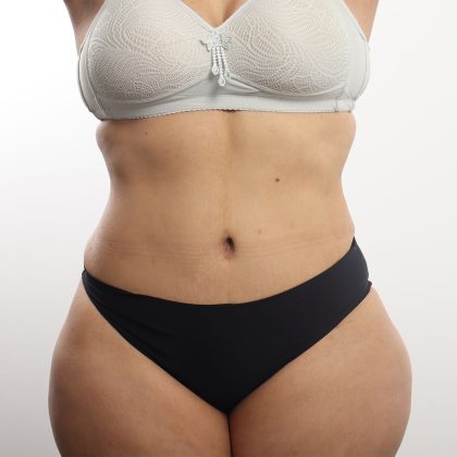 Tummy Tuck Before & After Patient #4452