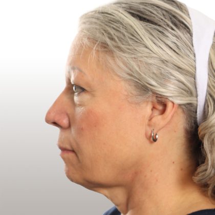 Facelift Before & After Patient #4461