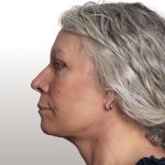 Facelift Before & After Patient #4461