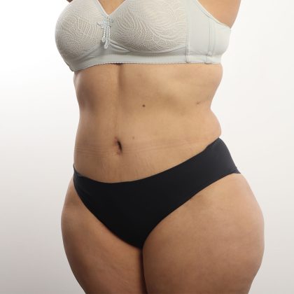 Tummy Tuck Before & After Patient #4452
