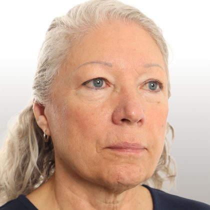 Facelift Before & After Patient #4461