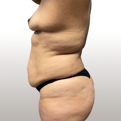Tummy Tuck Before & After Patient #4452