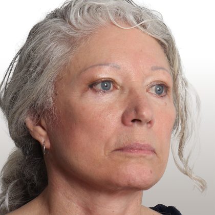 Facelift Before & After Patient #4461