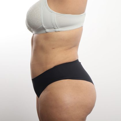 Tummy Tuck Before & After Patient #4452