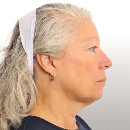 Facelift Before & After Patient #4461