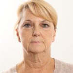 Facelift Before & After Patient #4517
