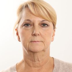 Facelift Before & After Patient #4517
