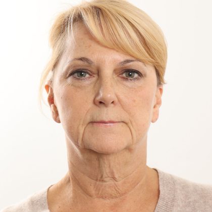 Facelift Before & After Patient #4517