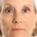 DOT Laser Before & After Patient #4495