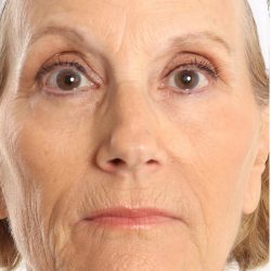 DOT Laser Before & After Patient #4495