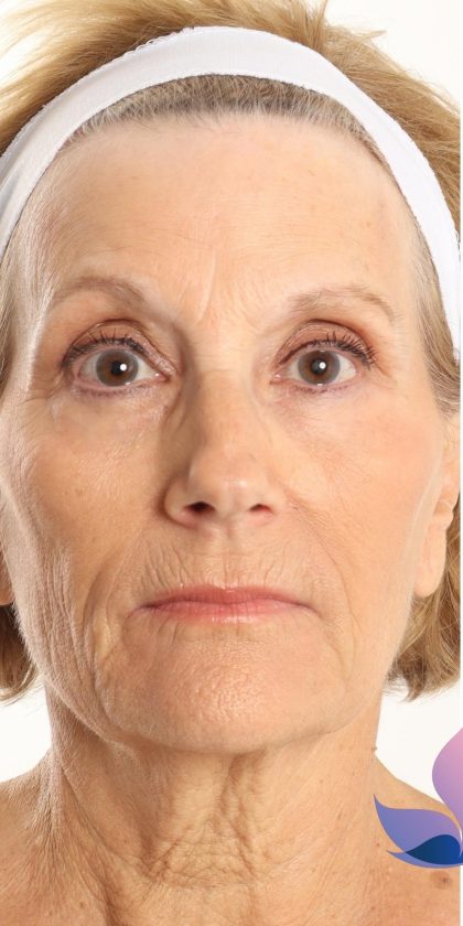 DOT Laser Before & After Patient #4495