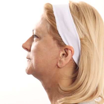 Facelift Before & After Patient #4517
