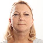Facelift Before & After Patient #4517