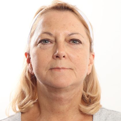 Facelift Before & After Patient #4517