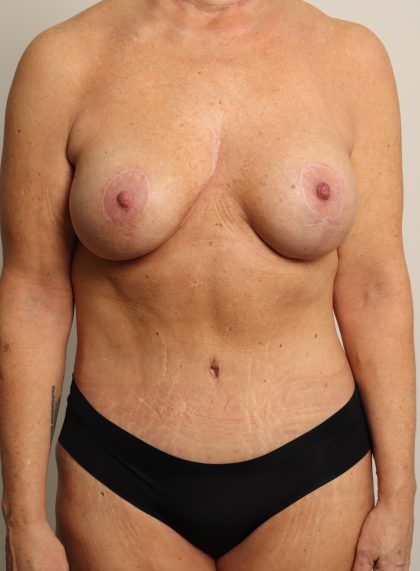 Breast Lift Before & After Patient #4491