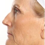 DOT Laser Before & After Patient #4495