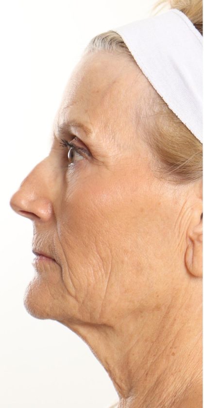 DOT Laser Before & After Patient #4495