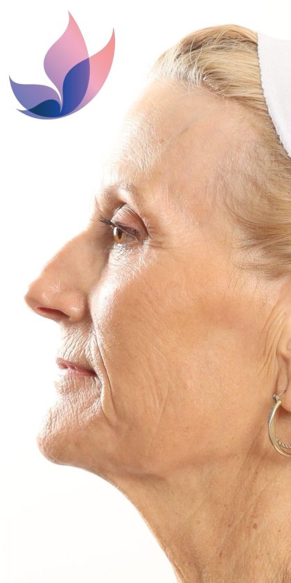 DOT Laser Before & After Patient #4495