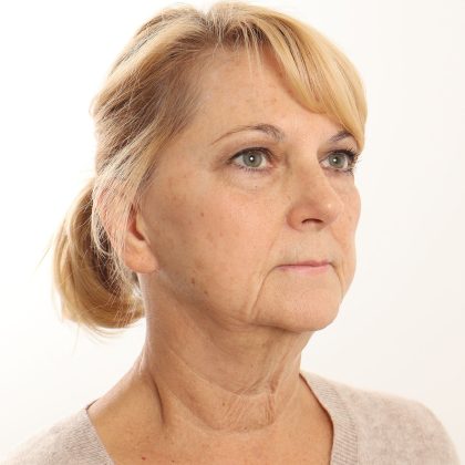 Facelift Before & After Patient #4517