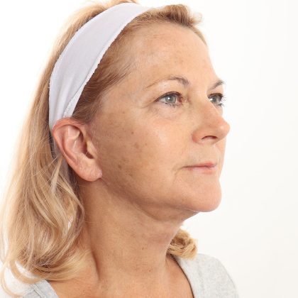 Facelift Before & After Patient #4517