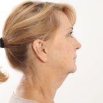 Facelift Before & After Patient #4517