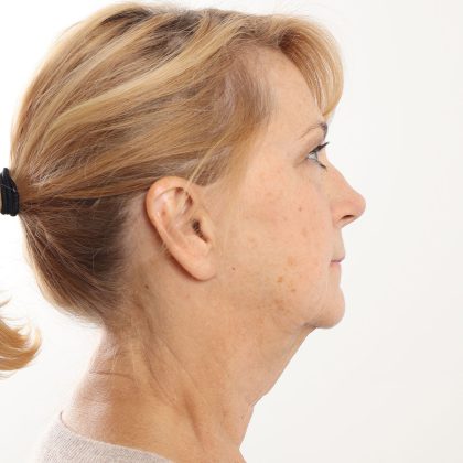 Facelift Before & After Patient #4517