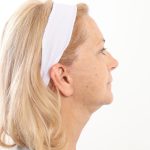 Facelift Before & After Patient #4517